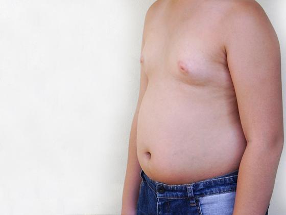 gynecomastia