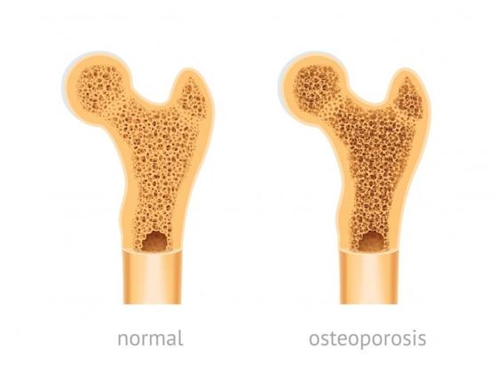 osteoporosis